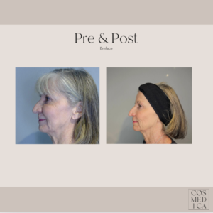 A before and after photo of a mature woman in a headband who received Emface near Ocala.